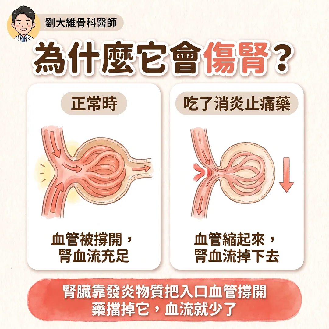 NSAID 類止痛藥全解析:常見種類、與普拿疼的差別、傷腎機轉與替代方案 衛教圖 5