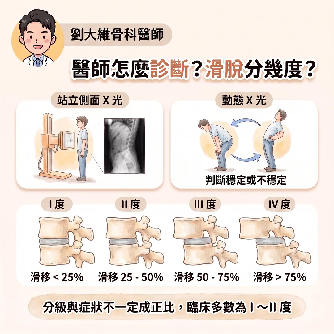 腰椎滑脫症是什麼?為什麼站久走久就腰痠腿麻?醫師教你怎麼預防 衛教圖 7