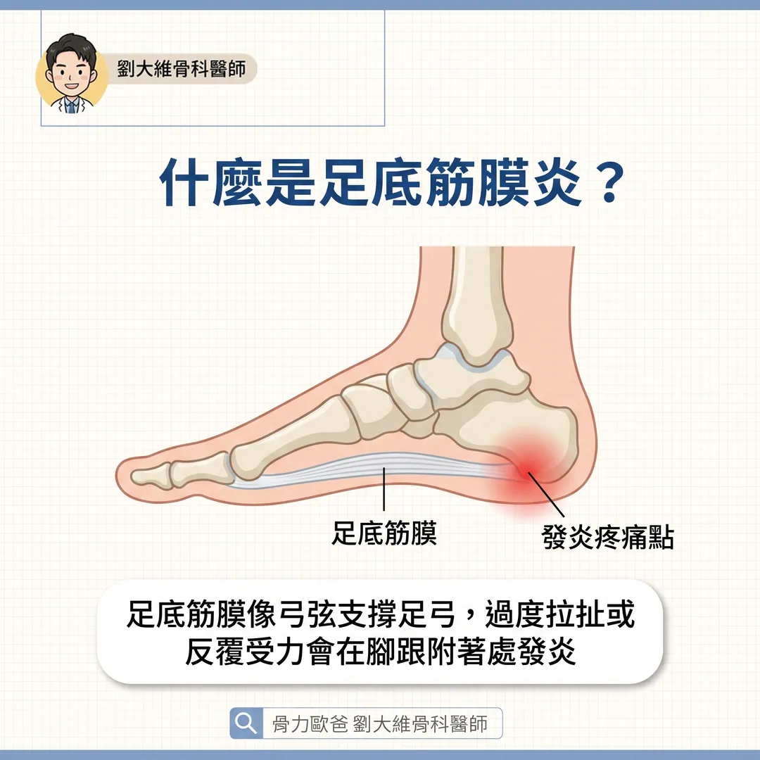 早上下床第一步腳跟像針刺？認識足底筋膜炎與正確保養 衛教圖 2