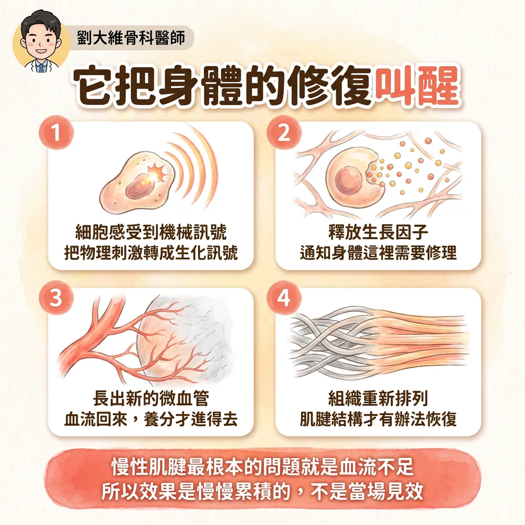 震波治療（ESWT）完整整理：原理、適應症、以及骨不癒合與骨壞死的應用 衛教圖 5