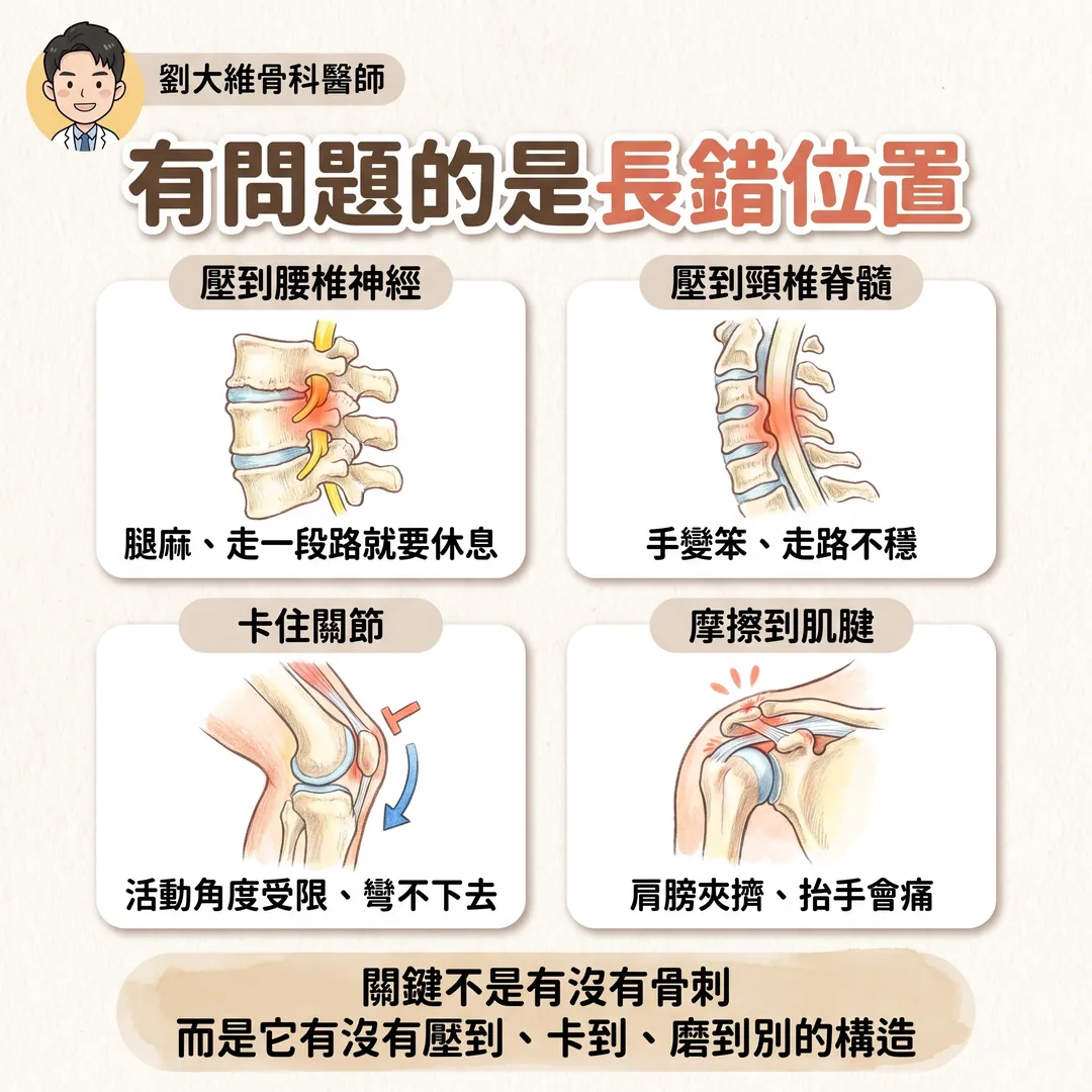 骨刺是什麼？一定要處理嗎？骨科醫師告訴你 衛教圖 4