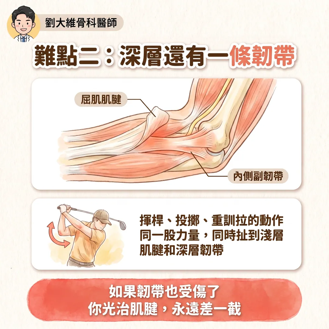 高爾夫球肘(內上髁肌腱病變):為什麼比網球肘難治 衛教圖 4